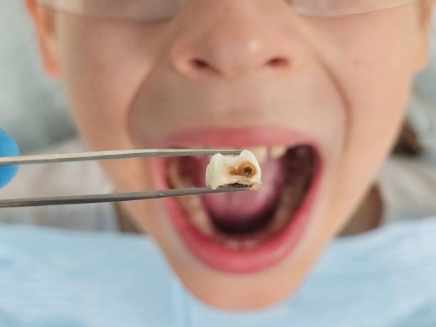 Best Emergency Dental Care for Abscessed Tooth in Suncoast Estates, FL